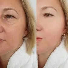 Armonización facial y toxina botulínica: estrategia clínica rentable